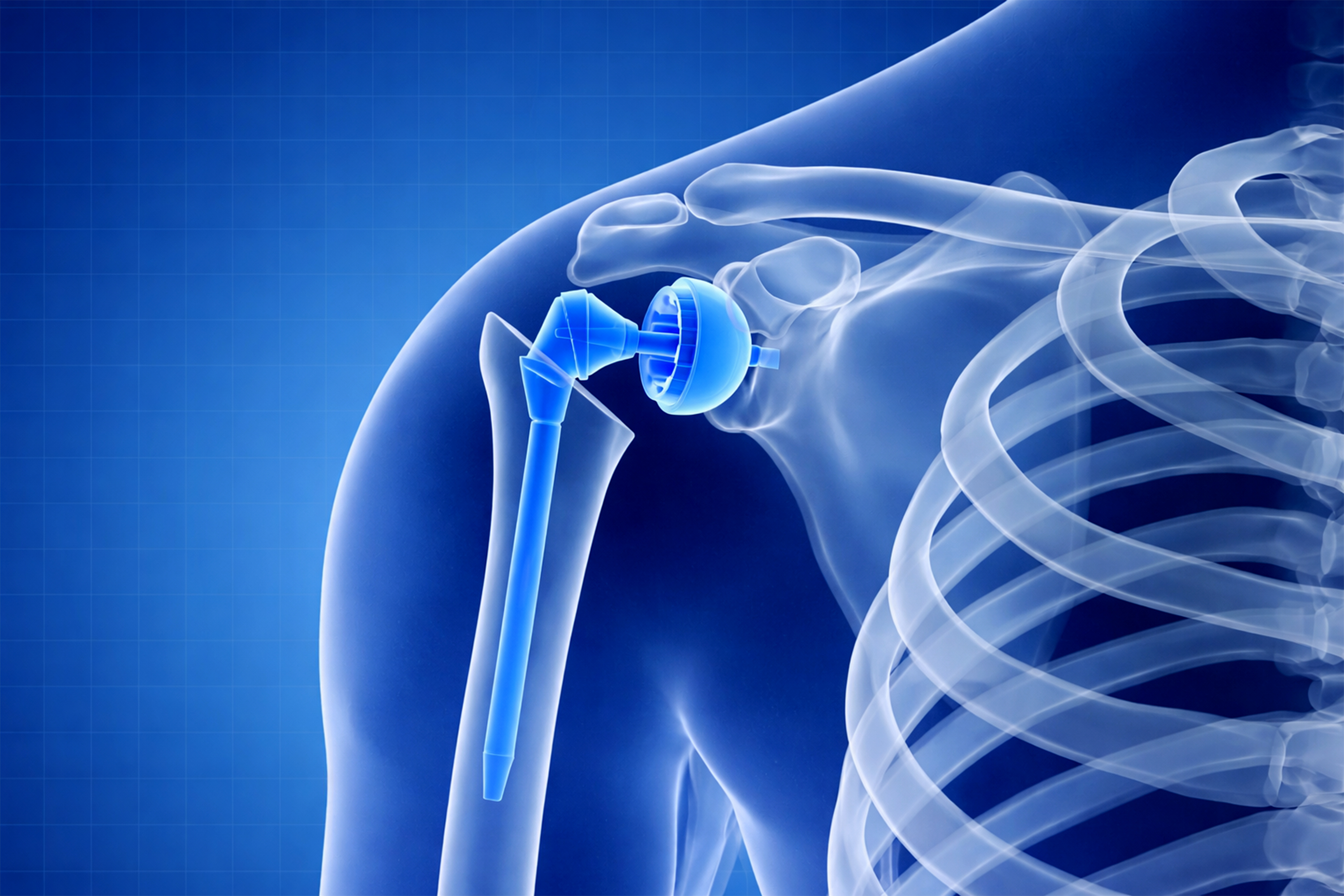 Shoulder Replacement